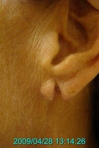 b Ear repair before