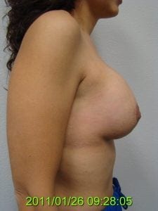 Breast Augmentation After 9