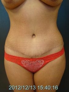 Tummy Tuck Patient After