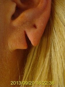 Before Repair and Repiercing