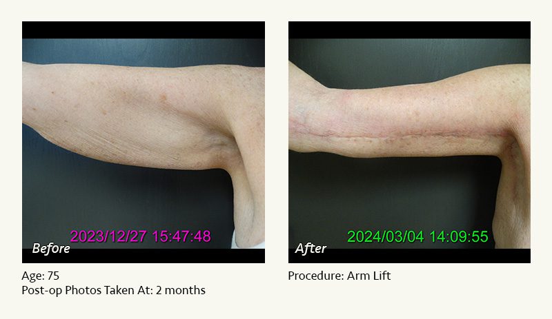 Arm Lift Surgery in Plano, TX - Patient 4