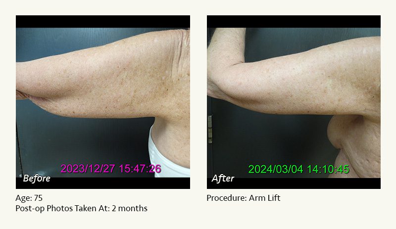 Arm Lift Surgery in Plano, TX - Patient 3