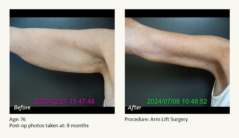 Arm Lift Surgery in Plano, TX - Patient 2
