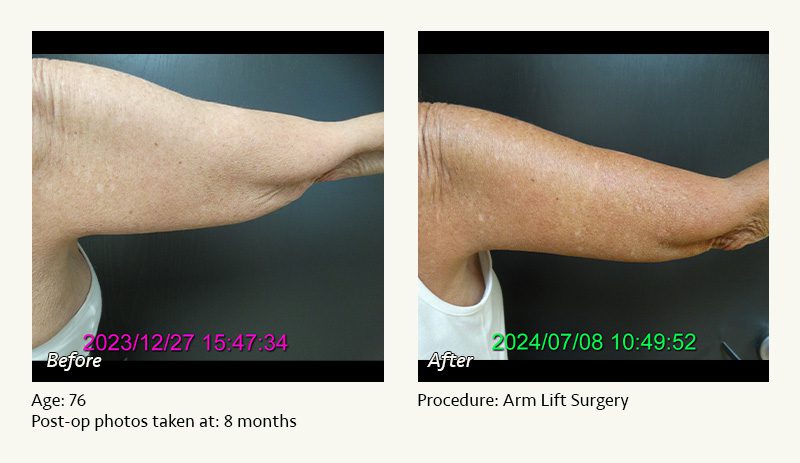 Arm Lift Surgery in Plano, TX - Patient 1