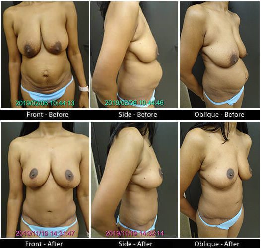 Mommy Makeover in Plano, TX - Patient 15