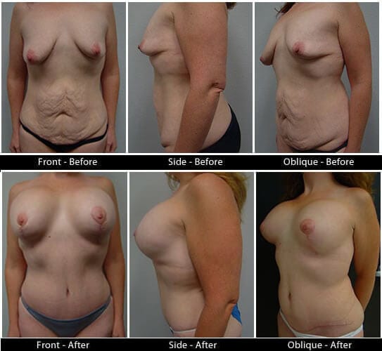 Mommy Makeover in Plano, TX - Patient 33