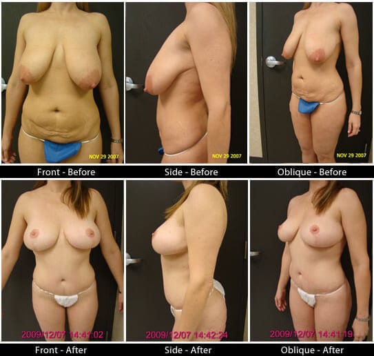 Mommy Makeover in Plano, TX - Patient 37
