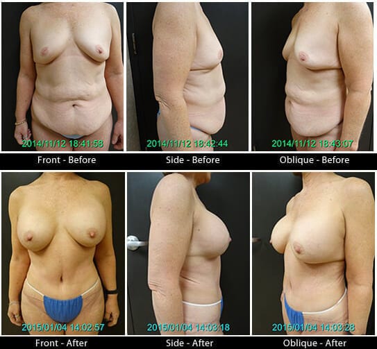 Mommy Makeover in Plano, TX - Patient 24
