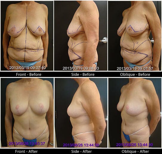 Mommy Makeover in Plano, TX - Patient 29