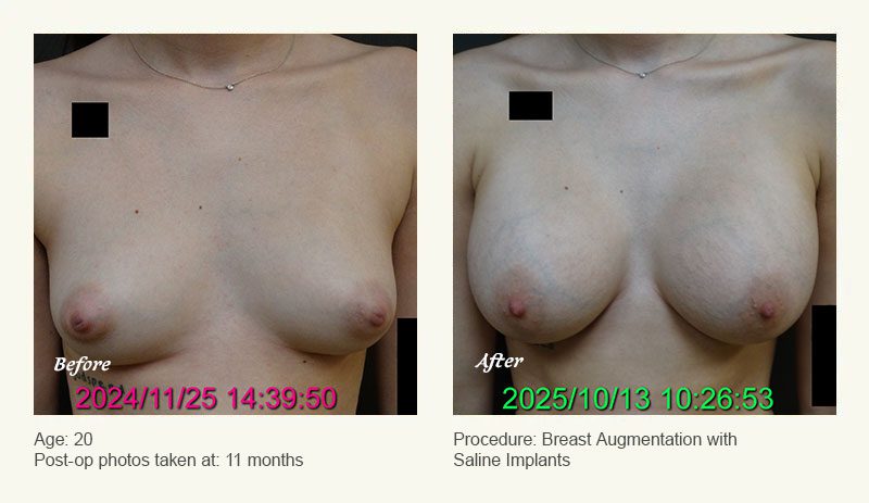 Breast Augmentation in Plano, TX - Patient 3