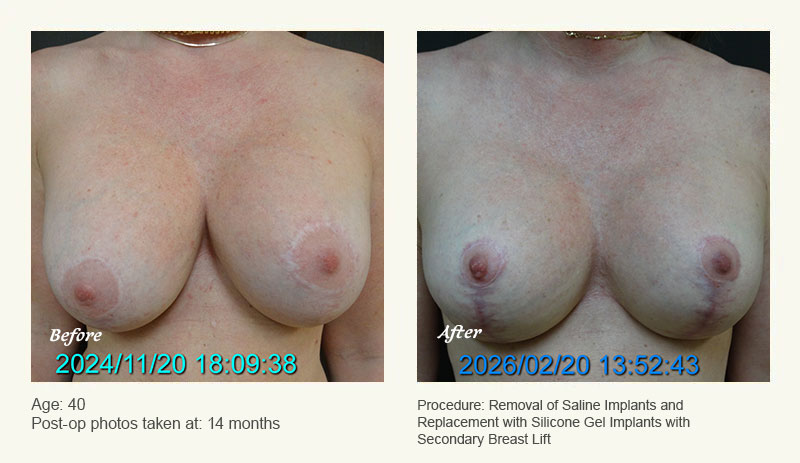 Breast Implant Revision in Plano, TX - Patient 7