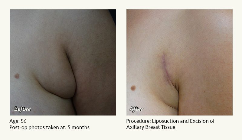 Body Contouring After Weight Loss in Plano, TX - Patient 2