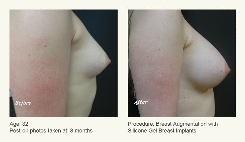 Breast Augmentation in Plano, TX - Patient 6