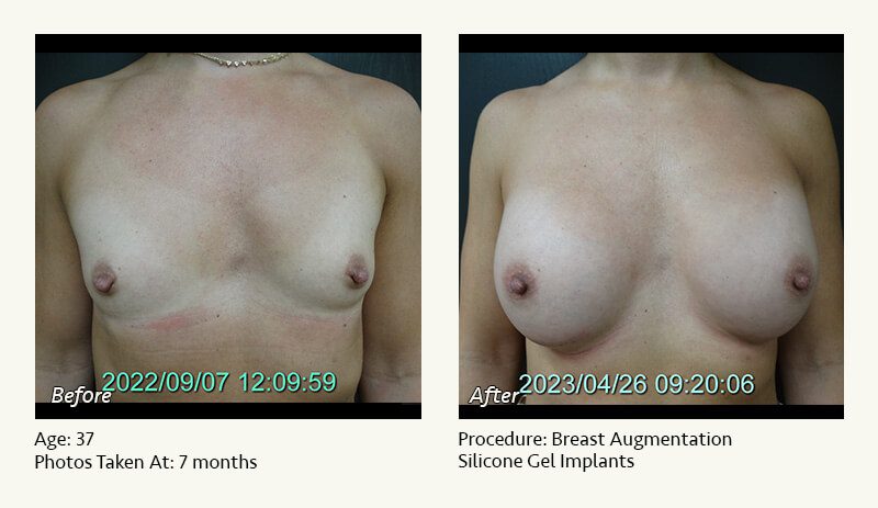 Breast Augmentation in Plano, TX - Patient 41