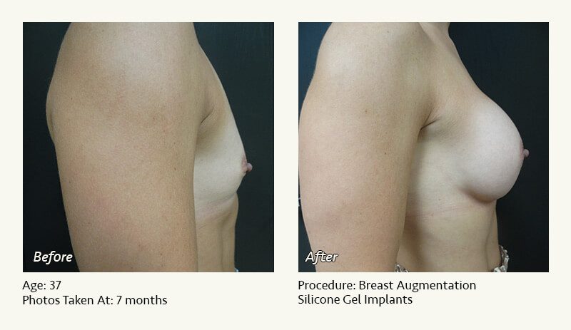 Breast Augmentation in Plano, TX - Patient 42
