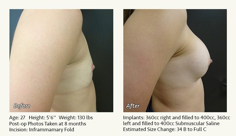 Breast Augmentation in Plano, TX - Patient 44