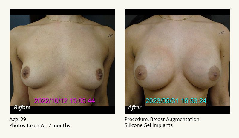 Breast Augmentation in Plano, TX - Patient 39