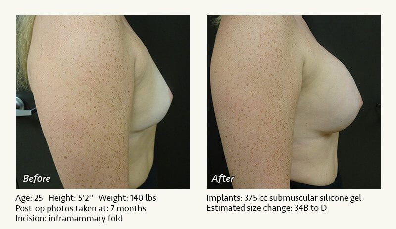 Breast Augmentation in Plano, TX - Patient 52