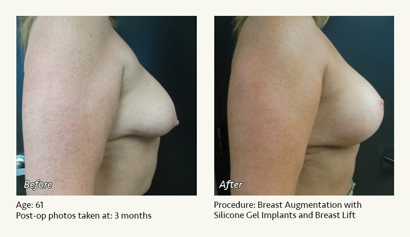 Breast Augmentation With Lift in Plano, TX - Patient 16