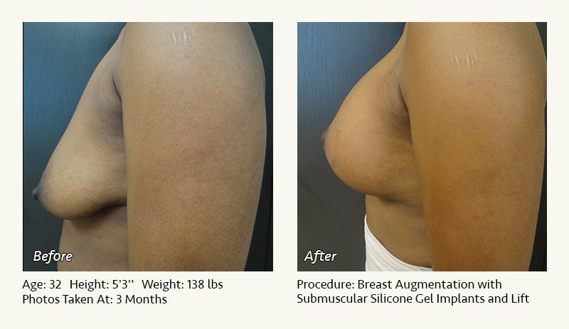 Breast Augmentation With Lift in Plano, TX - Patient 22