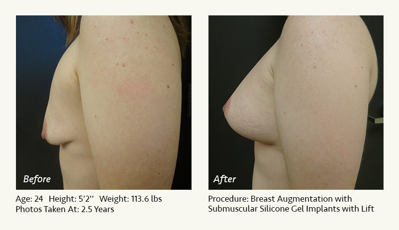 Breast Augmentation With Lift in Plano, TX - Patient 28