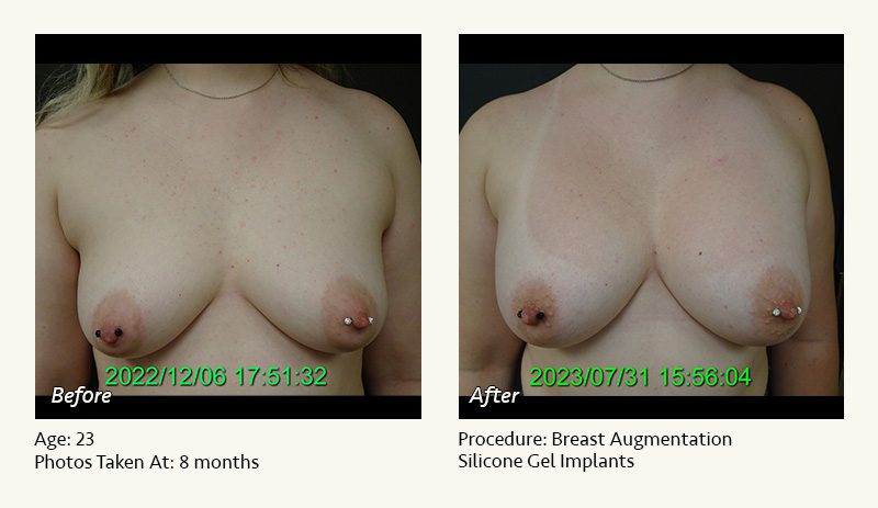 Breast Augmentation in Plano, TX - Patient 37