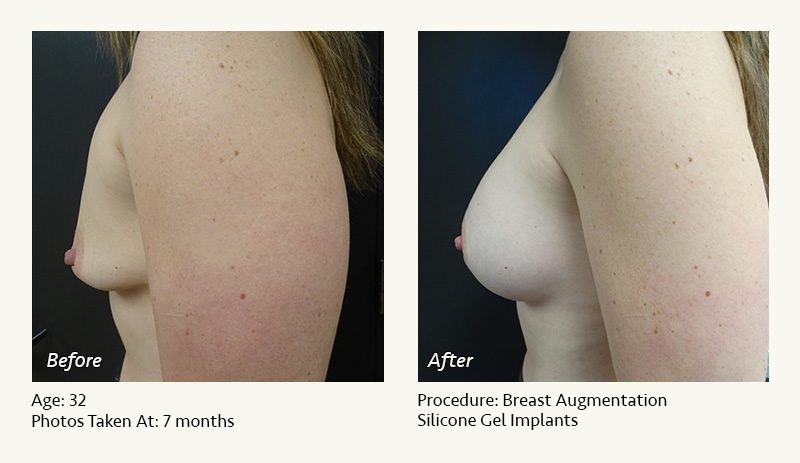 Breast Augmentation in Plano, TX - Patient 32