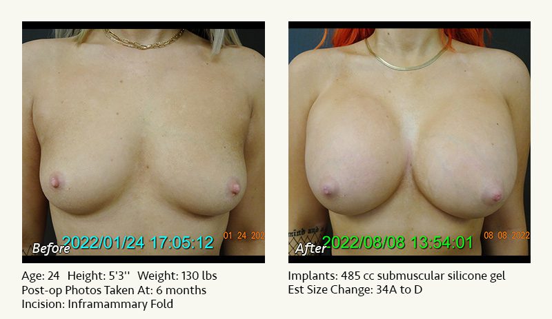 Breast Augmentation in Plano, TX - Patient 47