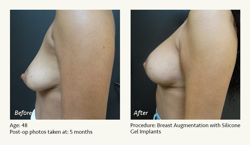 Breast Augmentation in Plano, TX - Patient 18