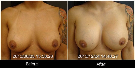 Breast Implant Revision Before & After 6 Front