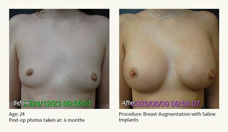 Breast Augmentation in Plano, TX - Patient 9
