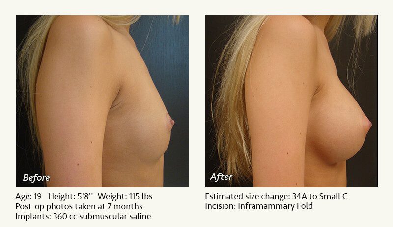 Breast Augmentation in Plano, TX - Patient 80
