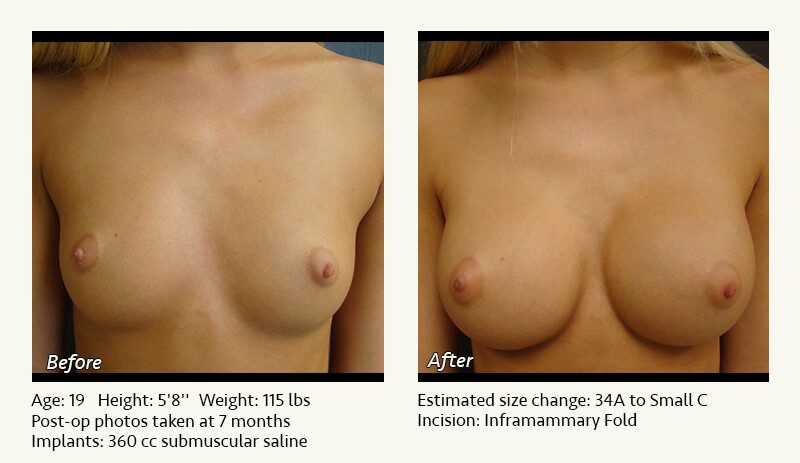 Breast Augmentation in Plano, TX - Patient 79
