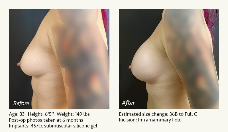 Breast Augmentation in Plano, TX - Patient 70