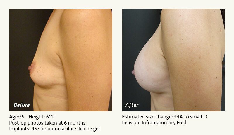 Breast Augmentation in Plano, TX - Patient 64