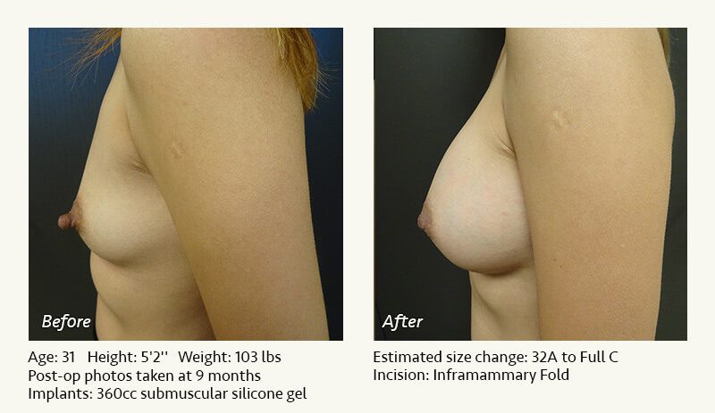 Breast Augmentation in Plano, TX - Patient 62