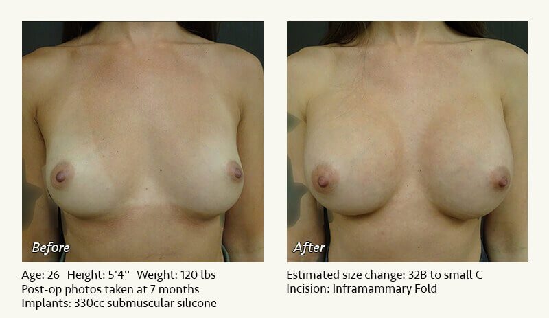 Breast Augmentation in Plano, TX - Patient 57