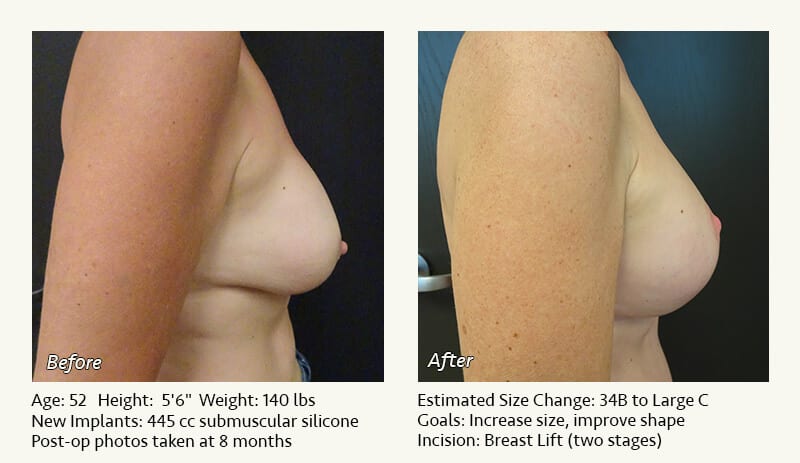 Breast Implant Revision in Plano, TX - Patient 92