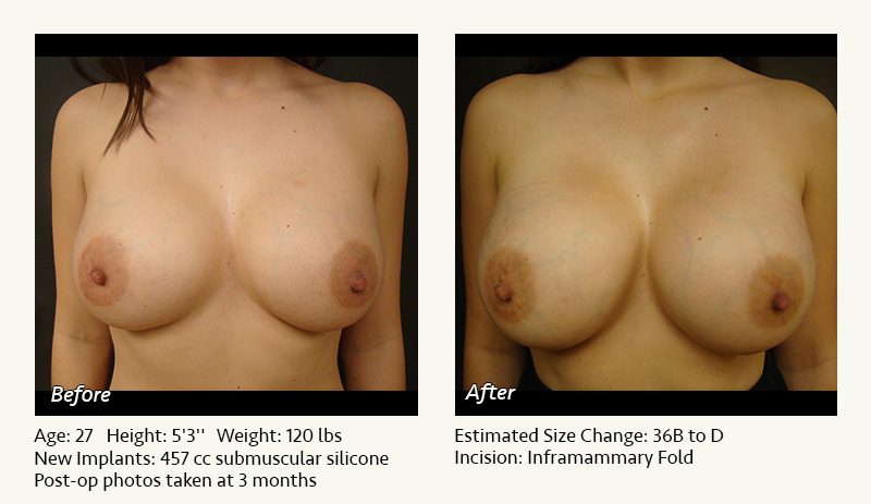 Breast Implant Revision in Plano, TX - Patient 75