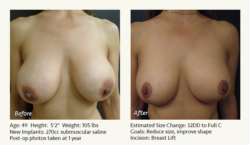 Breast Implant Revision in Plano, TX - Patient 93