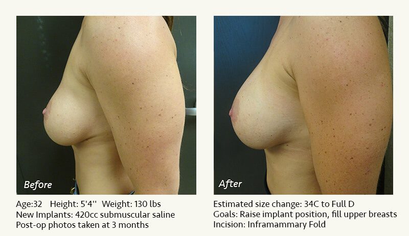 Breast Implant Revision in Plano, TX - Patient 72