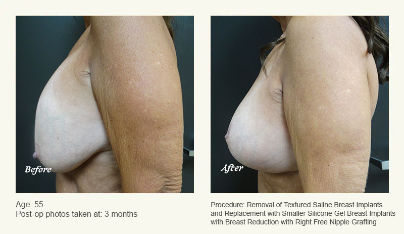 Breast Implant Revision in Plano, TX - Patient 16