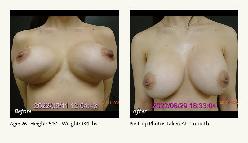 Breast Implant Revision in Plano, TX - Patient 51