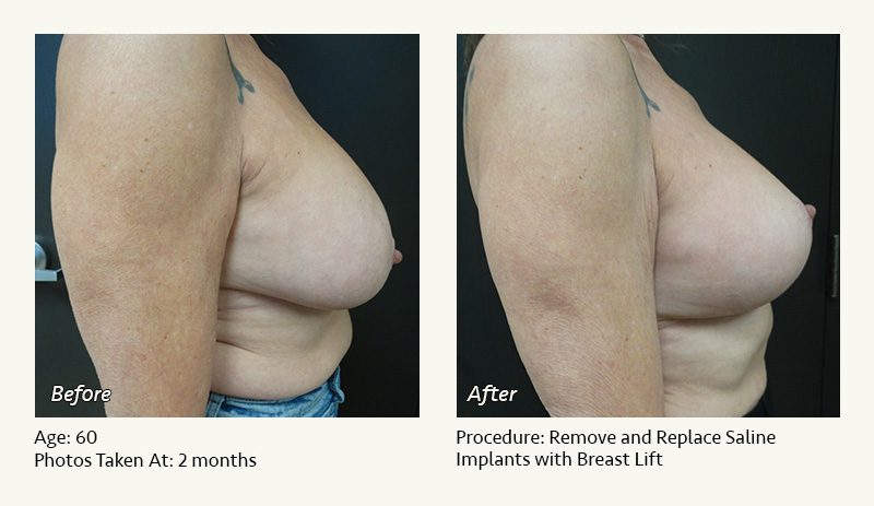 Breast Implant Revision in Plano, TX - Patient 46