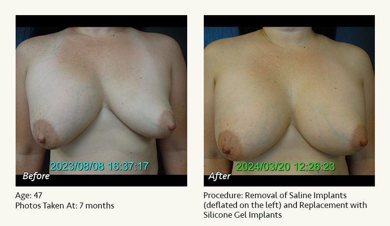 Breast Implant Revision in Plano, TX - Patient 43