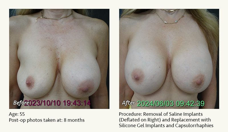 Breast Implant Revision in Plano, TX - Patient 41