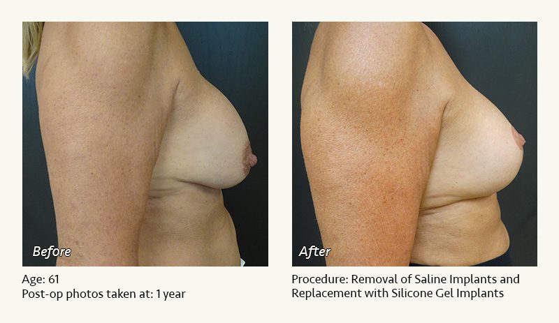 Breast Implant Revision in Plano, TX - Patient 40