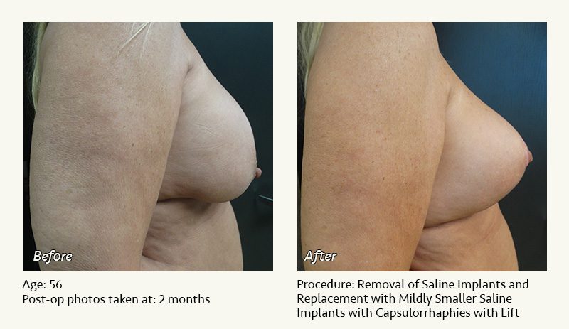 Breast Implant Revision in Plano, TX - Patient 38