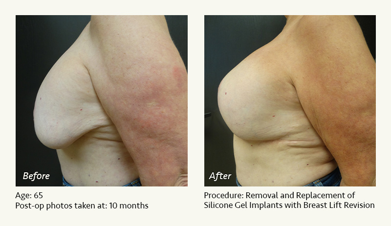 Breast Implant Revision in Plano, TX - Patient 12