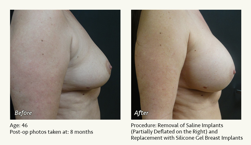 Breast Implant Revision in Plano, TX - Patient 10